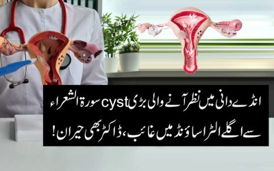 Cyst Ka Ilaj Surah Shuara Se