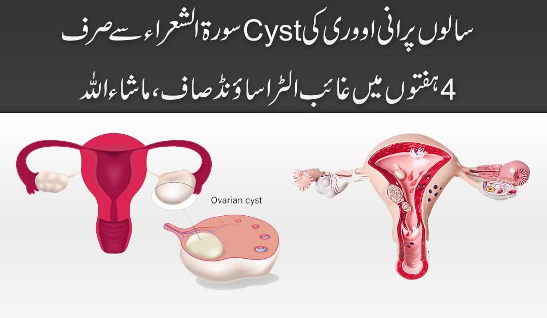 Ande Dani Mein Cyst Pani Ki Theliyan Ka Quran Mein Ilaj