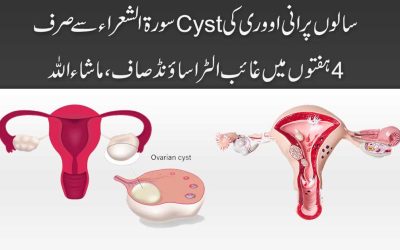 Cyst Se Shifa Ka Naqsh